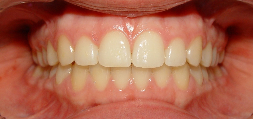 gums-and-teeth